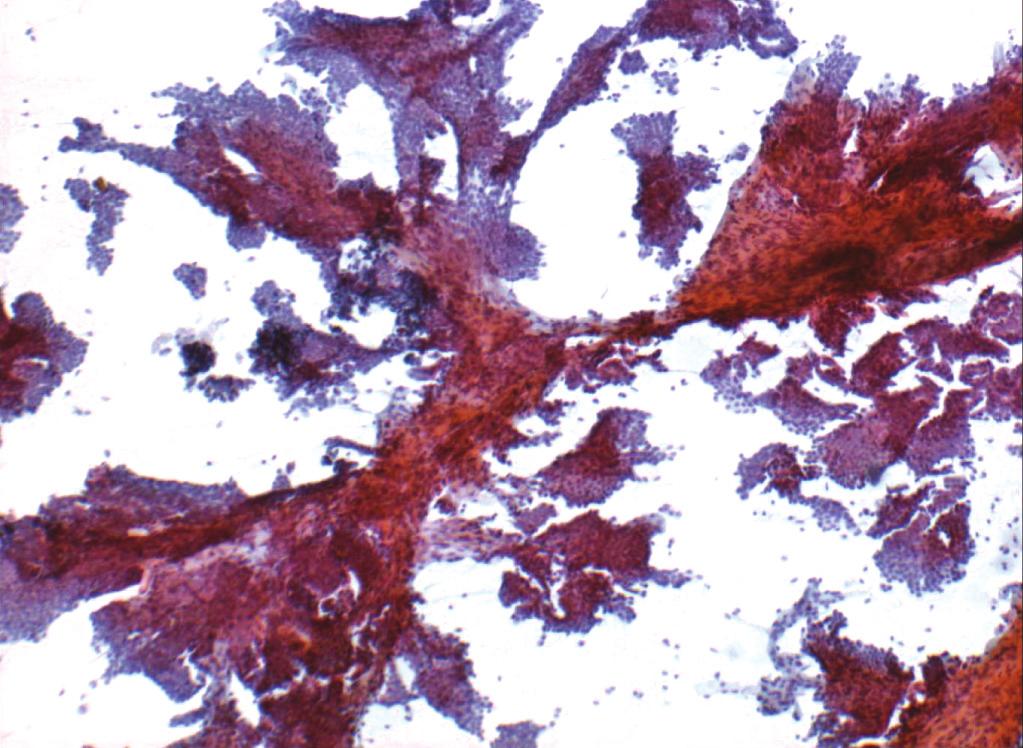 박경미 : 유방 세침흡인 세포검사의 진단적 함정 Fig. 1. Papillary clusters.