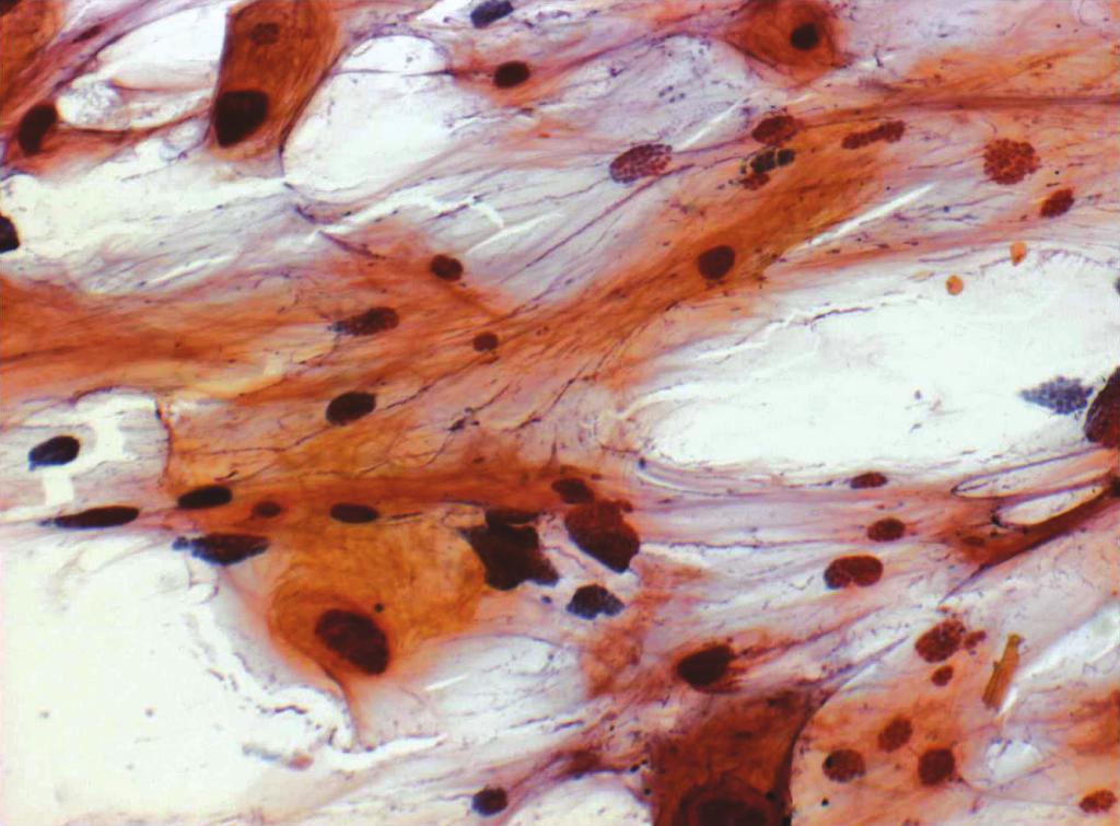 background. (Papanicolaou). Fig. 3. Stromal tissue.