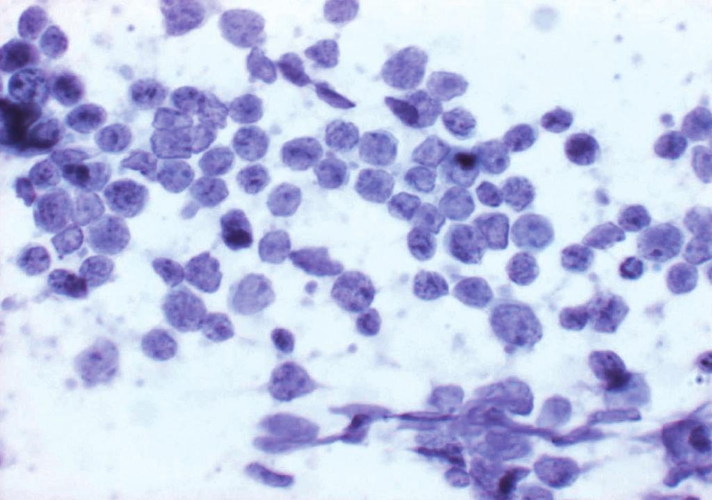 Fig. 7. Lobular carcinoma. Small, monomorphic cells and loosely cohesive small groups are noted. (Papanicolaou). Fig. 8. Non-Hodgkin's lymphoma.