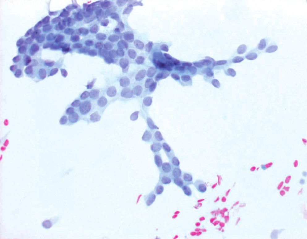 Fig. 9. Tubular carcinoma. Monotonous neoplastic cells consist of epithelial cells only with lumen formation. (Papanicolaou). Fig. 10. Papillary carcinoma.