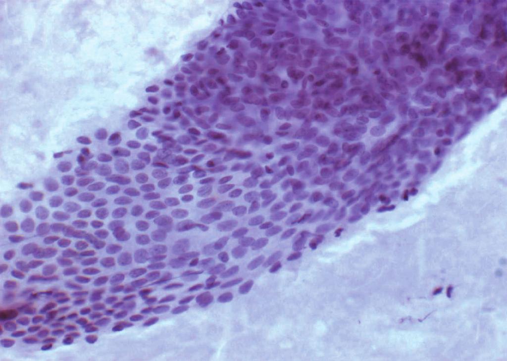 Fig. 12. Duct ectasia. Benign clusters of epithelial and myoepithelial cells with amorphous degenerating material are noted. (Papanicolaou). Fig. 14. Lactation adenoma.