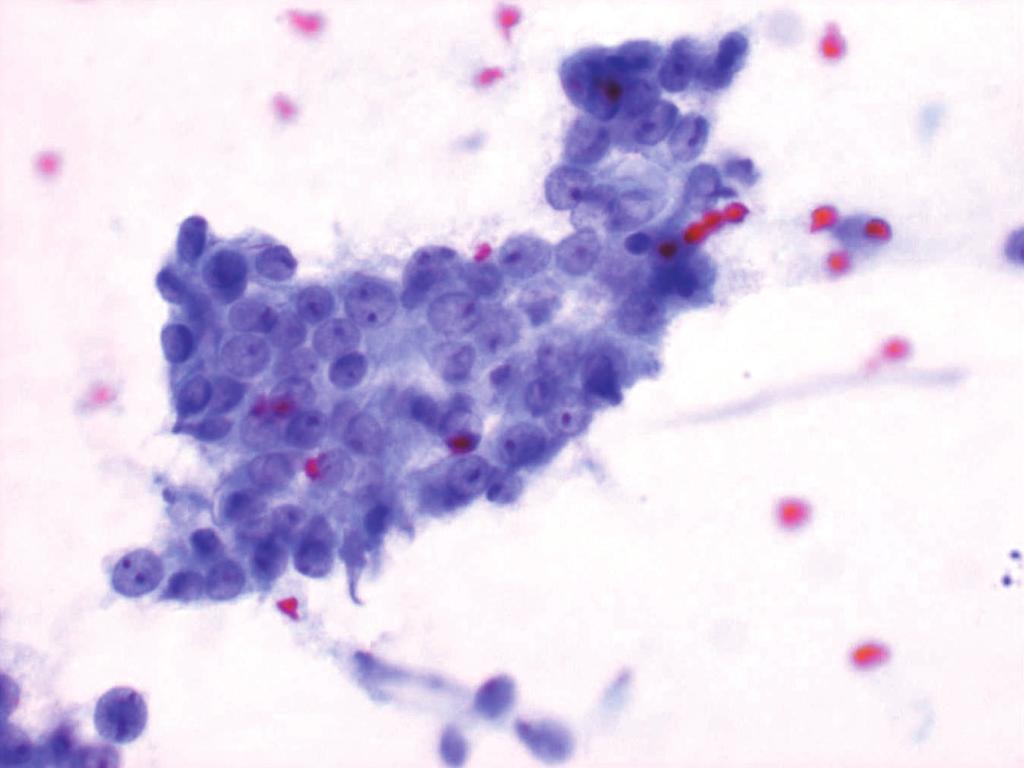 Activated epithelial cells and macrophages are present in inflammatory background. (Papanicolaou). 결 론 이상과같이유방병변의세포학적진단은난이도가매우높고함정이많기때문에많은시간의훈련이필요하며결국경험이풍부한세포병리전문의가시행하고판독하는것이바람직하다.
