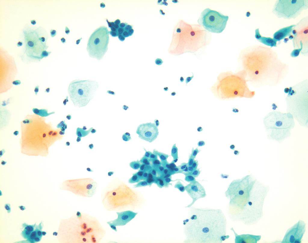 293 자궁경부의 액상 세포검사 보이고, 흔히 개개로 흩어진 자궁 내경부 세포를 볼 수 있으며 이 들은 미숙한 편평상피화생세포(immature squamous metaplastic cells), 저장세포(reserve cells) 혹은 조직구와 유사하게 보일 수 있다.