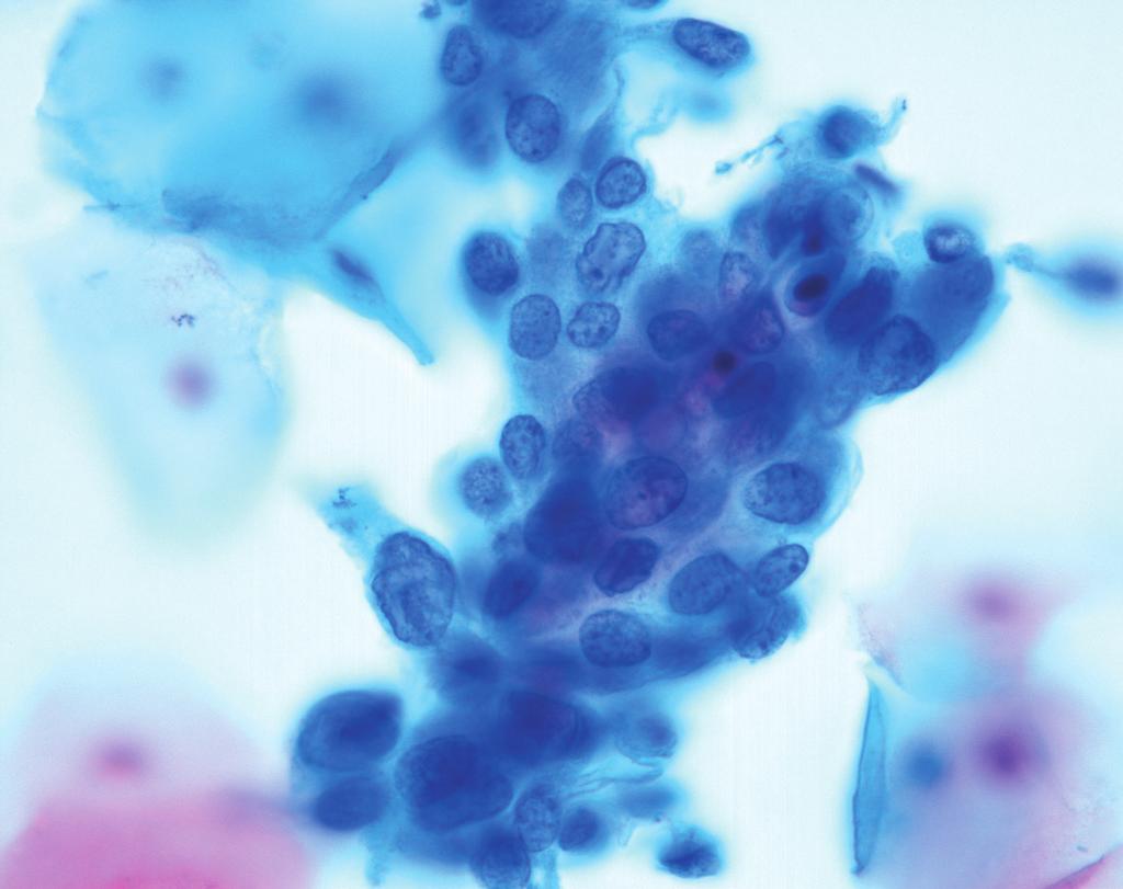 자궁내 막 샘상피세포는 촘촘한 삼차원적 구조의 세포군집 형태가 유지 되나 세포군집을 이루는 세포가 성글게 배열하며 세포질 내에는 공포가 관찰된다(Fig. 3). 고전적 자궁경부 세포진 검사법에 비 해 역시 낱개의 세포로 흩어지는 경향이 있다.