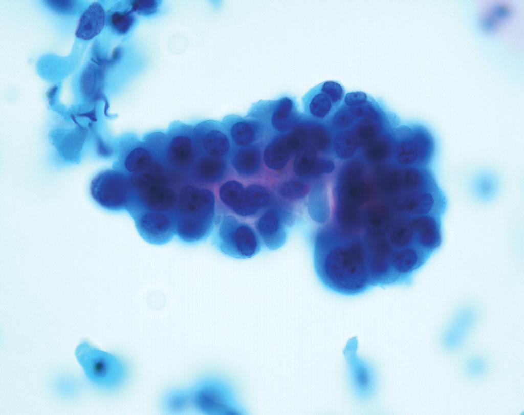 296 이용희 A B C D Fig. 4. Comparison of squamous cell carcinoma and endocervical adenocarcinoma. (A) Squamous cell cluster reveals ragged group edges with dense homogeneous cytoplasm.
