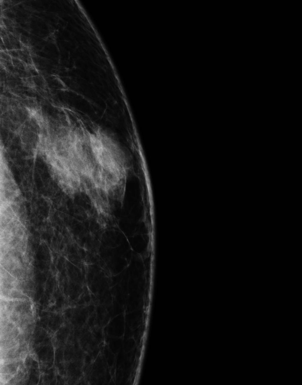 김혜정외 Fig. 3. Nodular gynecomastia (type 1) in a 48-year-old man. Mammogram () shows a small fan-shaped density radiating from the nipple. On ultrasound (), small amount of glandular tissue is seen.