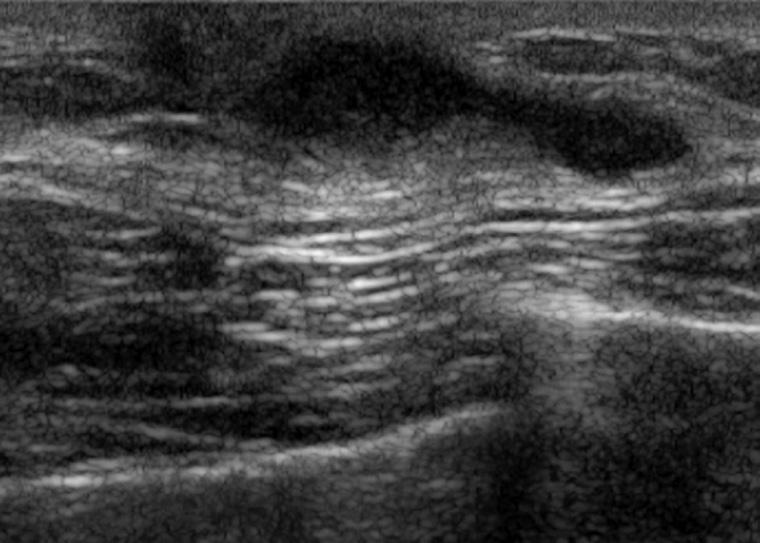 The mass is composed of benign looking ducts and periductal myxoid stroma (, 200). C Fig. 9.