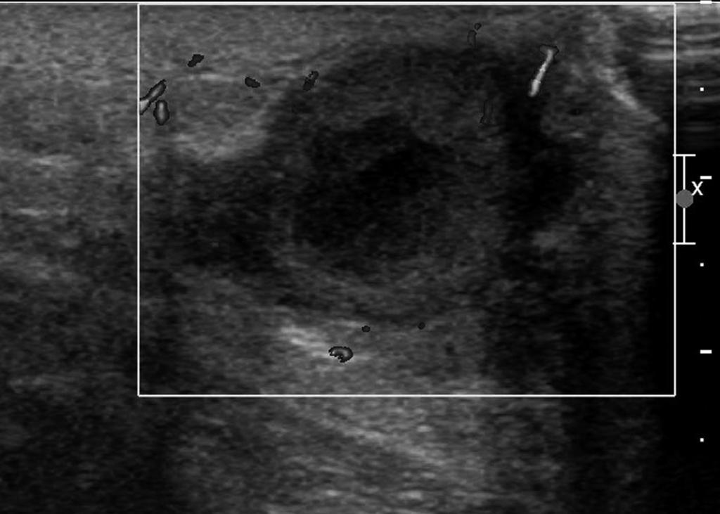 Calcifications (arrow) are visible within the mass.