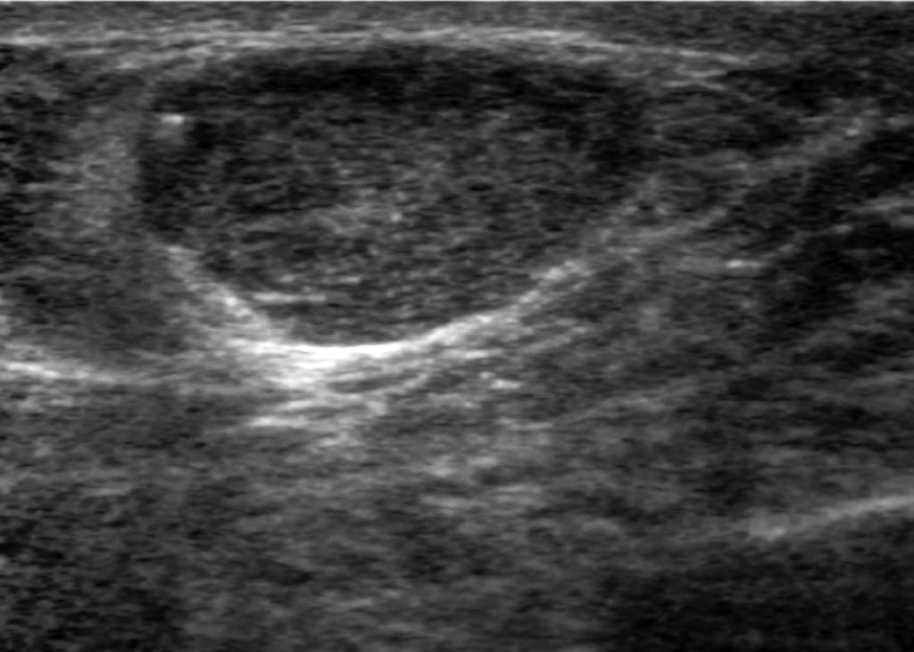 Color Doppler US () image shows some increased vascularity at peripheral solid portion of the mass.