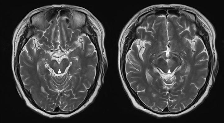 - 박선경외 : 두단계로수술한양측성핵간안근마비 - Figure 2. Brain magnetic resonance imaging.