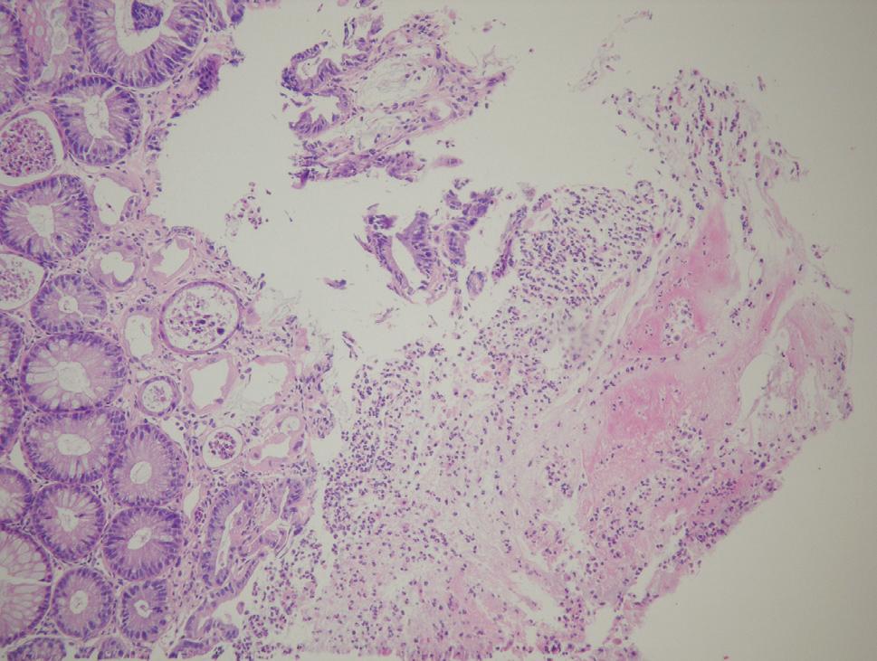 - 강성주외 6 인 : 흉수와복수를동반한위막성대장염 1 예 - Figure 4. Microscopic findings. A focal explosive mucosal lesion is composed of mucus and neutrophils attached to the surface of the mucous gland (H&E stain, 40).