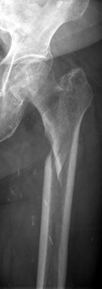 (D, E) The fracture was reduced satisfactorily using cable grip and proximal