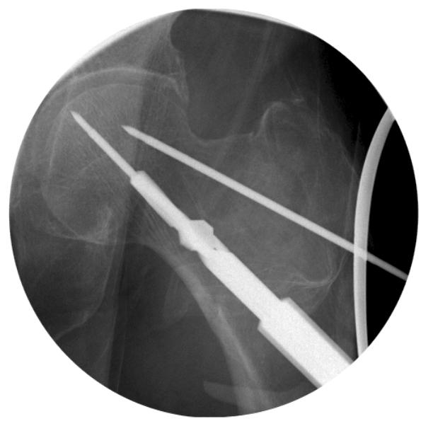(A) Intraoperative C-arm image shows reaming