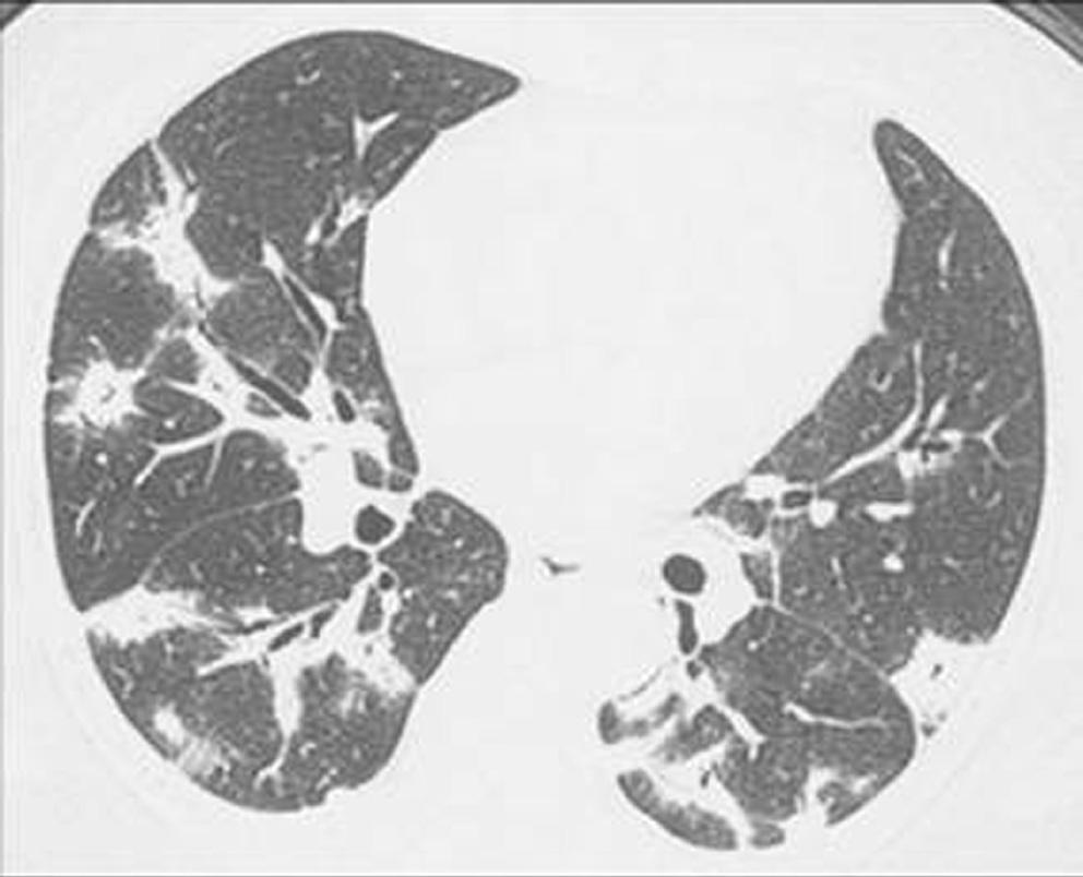 Bronchoscopy and bronchoalveolar lavage revealed pulmonary hemorrhage. Her hemoglobin level dropped to 4.7 g/dl. Fig. 27. Cryptogenic organizing pneumonia in a 53-year-old woman.