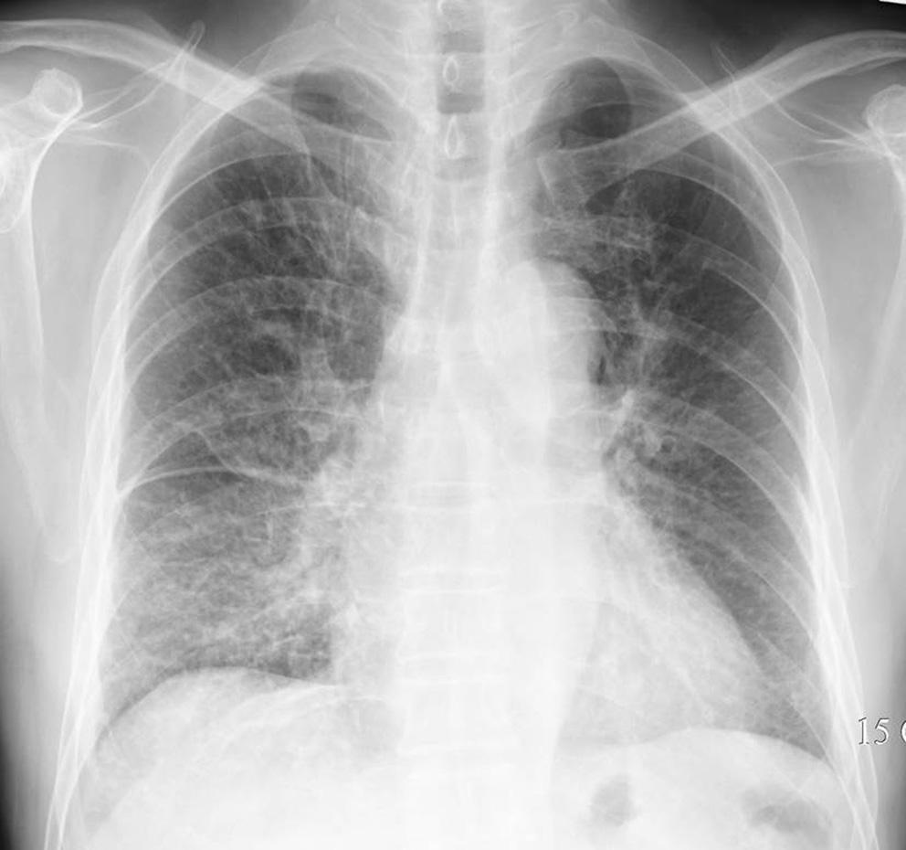 Fig. 2. Lymphangitic carcinomatosis in a 50-year-old woman. Chest radiograph shows a diffuse increase in interstitial markings in both lungs.