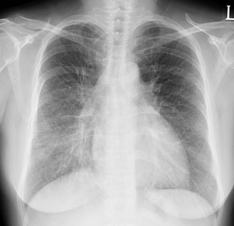 The diagno- sis was confirmed with transbronchial lung biopsy. Fig. 1. Hydrostatic pulmonary edema in a 77- year-old man.