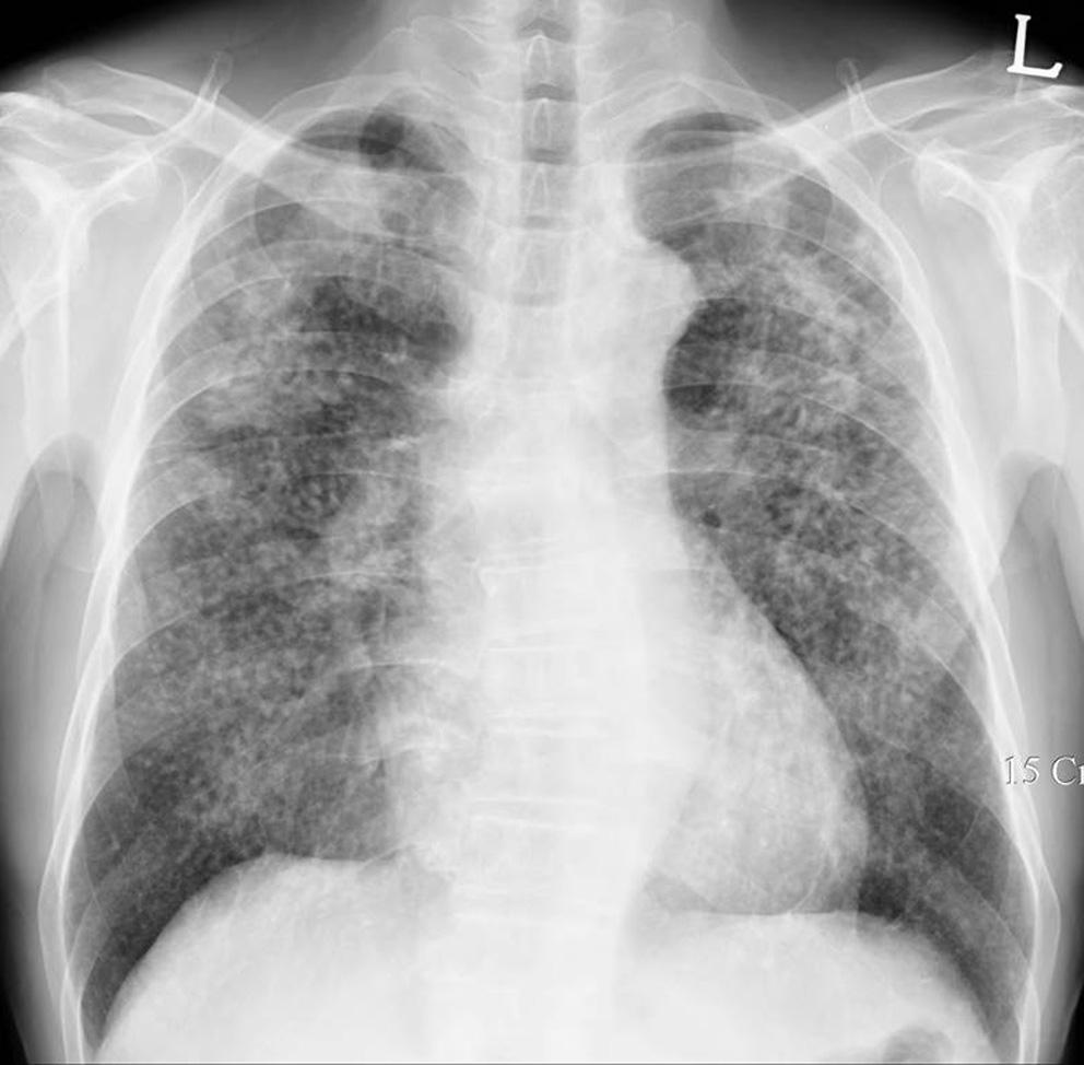 The nodules are typically very sharply marginated and progressive massive fibrosis is seen in upper lung zone with peripheral cicatricial emphysema.