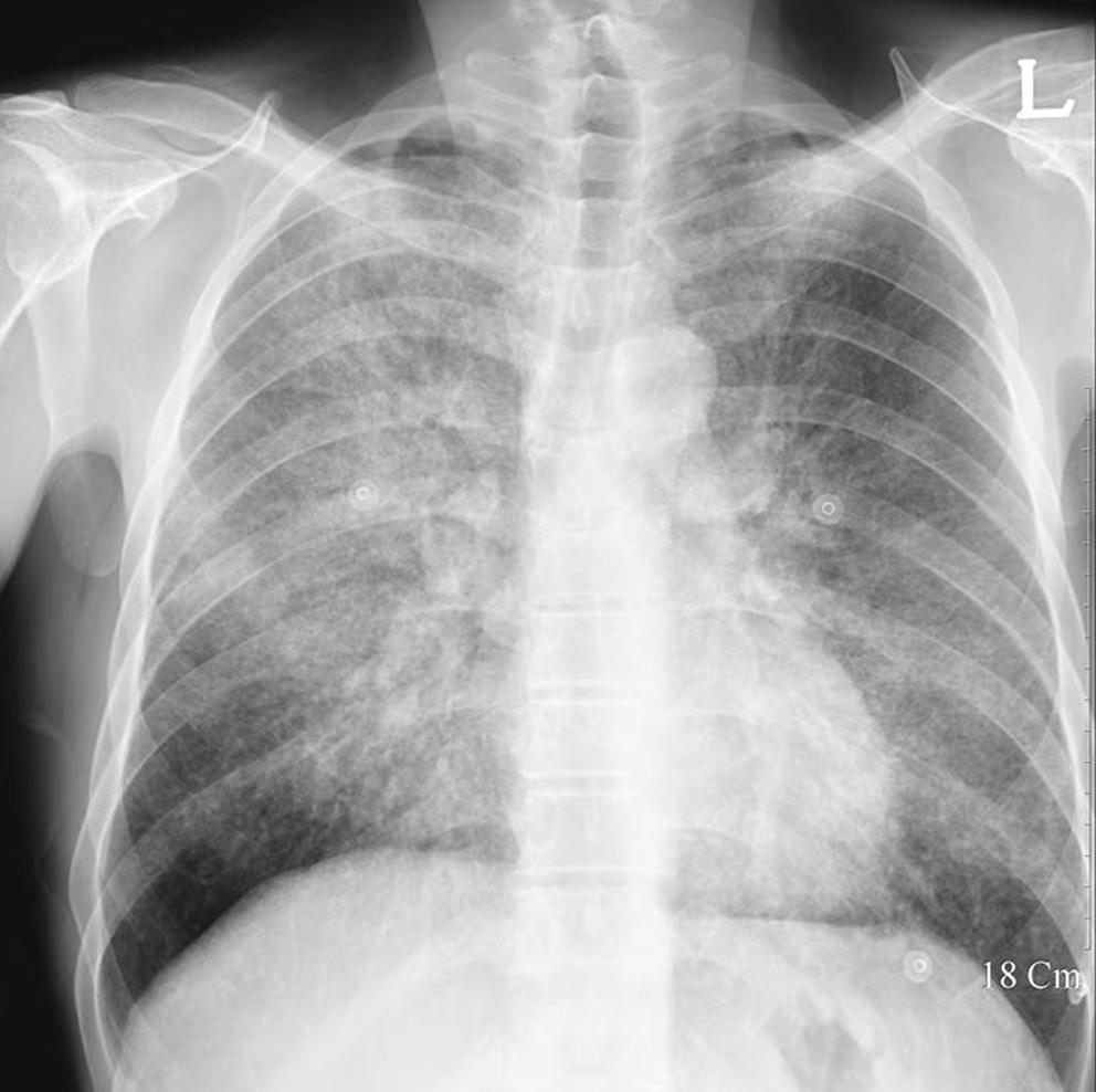 Fig. 11. Pneumocystis carinii pneumonia in a 53-year-old man with AIDS. Chest radiograph shows slightly increased overall opacity of the lungs.