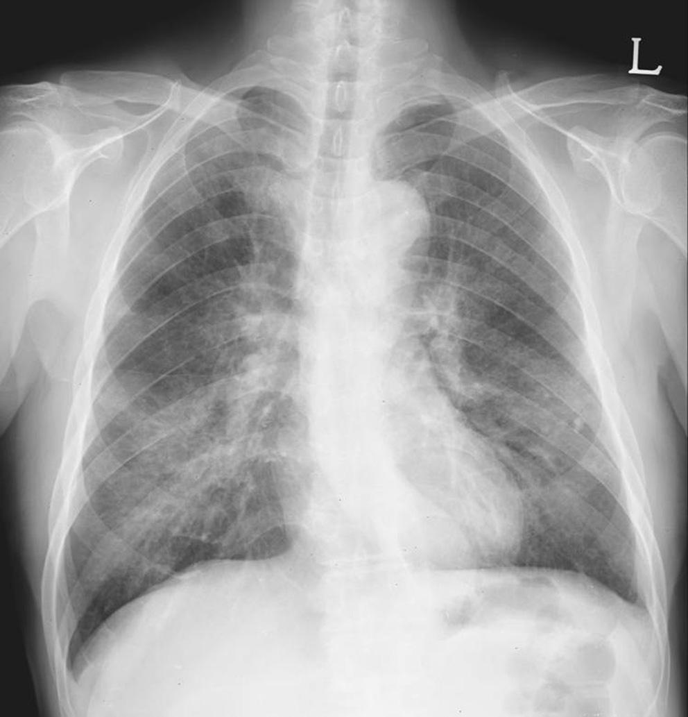 Pneumocystis carinii pneumonia is the most common cause of ground-glass pattern in patients with AIDS. 507 Fig. 12. Pulmonary alveolar proteinosis in a 66-year-old man.