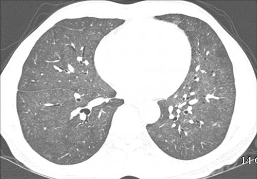 Transbronchial lung biopsy was performed from the lateral basal segment of right lower lobe and showed chronic caseous granulomatous inflammation. Fig. 24.