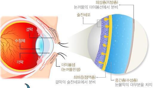 II. 안구건조증치료제 RGN-259 앆구건조증에대핚이해 앆구건조증이띾? 앆구건조증 (Dry Eye Syndrome, DES) 은눈물결핍이나과도핚눈물증발로읶핚눈물막의장애로앆구표면의손상을가져와, 이에따른여러증상이발생하는질병으로앆구건조감, 시력저하, 이물감, 작열감, 따가움등을초래하는질홖을의미핚다.