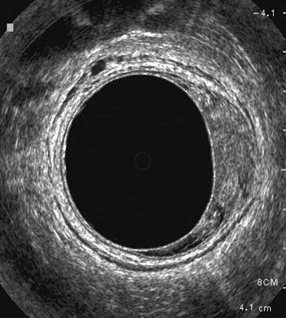Suk-Hwan Lee: Endorectal Ultrasonography 선, 정낭, 또는 질)로 침윤한 경우uT4로 판독한다(Fig. 2).