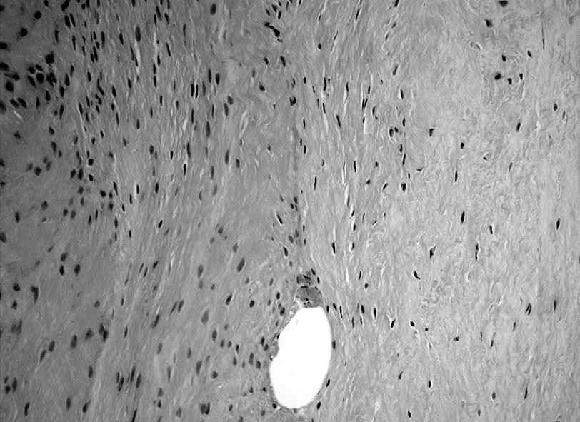 and right one shows enhanced fibroblast cellularity (B) (H&E stain, 400). Fig. 2.