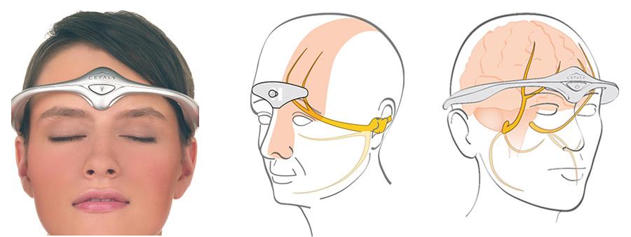 손종희 A B Figure 1. Neurostimulation for preventive treatment of migraine. (A) Transcutaneous supraorbital neurostimulation (Cefaly device), (B) transcutaneous vagus neurostimulation (GammaCore device).