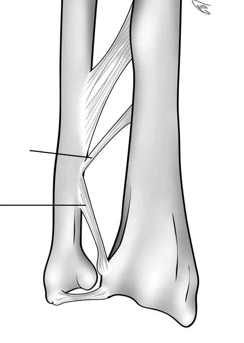 특히원위사선형다발 (distal oblique bundle) 은최근에중요성 이부각되고있는구조물로 40% 의비율로원위골간막내에서존 재하며척골원위약 1/6 위치에서 S 상절흔방향으로주행하고, 회외전과회내전시등척점 (isometric point) 이되는약 1.2 mm 두 께의구조물이다 (Fig. 2). 임상적으로척골절골술에서근위절골 Figure 3.