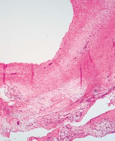즉단독으로골낭종만발생한경우를 type I, 16예 (purely intraosseous lesion, case 1) (Fig. Fig. 4.
