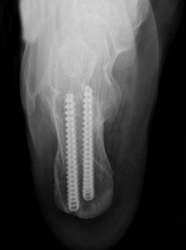 Follow-up radiographs at postoperative 1 year () show the restoration of hindfoot alignment. 의 굳은 살은 모두 소실되었다.