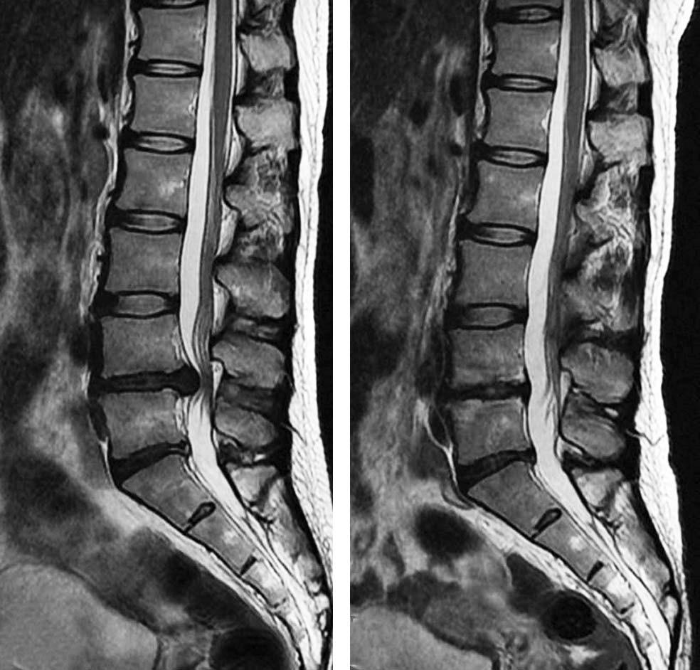 Hyoung Bok Kim et al Volume 25 Number 4 December 31 2018 A Fig. 1. Magnetic resonance imaging (MRI) findings. (A) Initial MRI, showing a large area of disc extrusion at the L4/5 disc space.