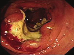 () PET scan shows high FDG uptake in the proximal colon and hepatic flexure of the ascending colon. 을보였다. 결막은창백하지않았고, 공막황달은관찰되지않았다.