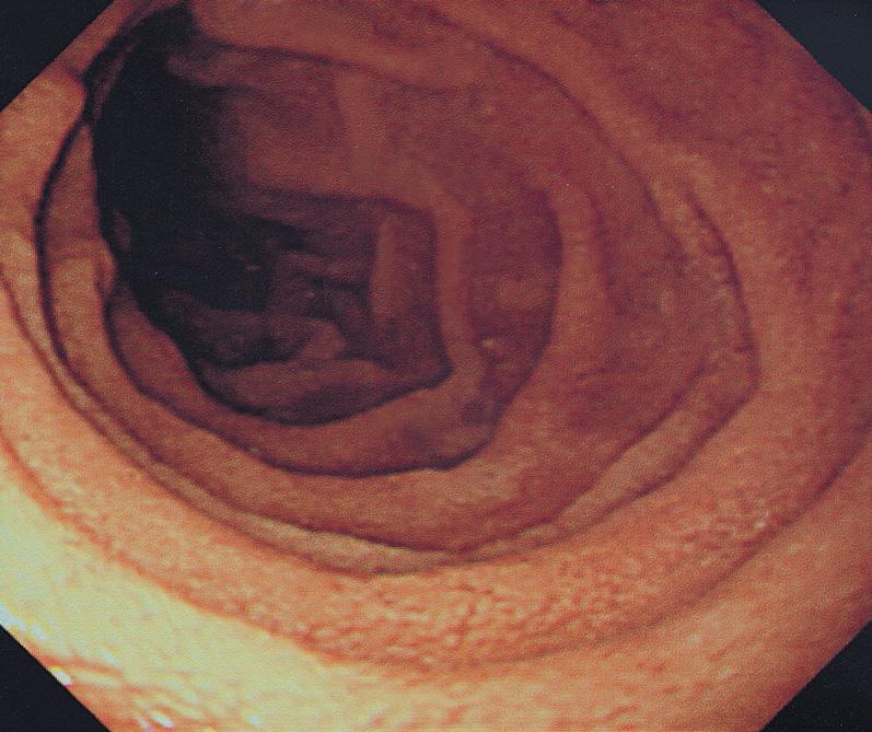 106 대한소화기내시경학회지 2007;35:105-109 Figure 1. Endoscopic findings of the duodenum. There is no specific lesion on the duodenum. 분, 체온 35.6oC였다. 신체검사에서 복부 전체에 복통을 호소하였고 압통 및 반사압통은 없었다.