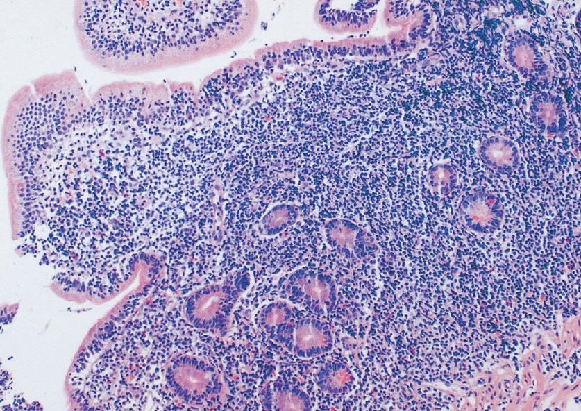 (B) It shows the massive proliferation of the CD3-positive malignant T-cells throughout the lamina propria and intraepithelial lymphocytes (CD 3 immunostain, 250). 림프종중장병연관성 T- 세포림프종은매우드문질환이다.