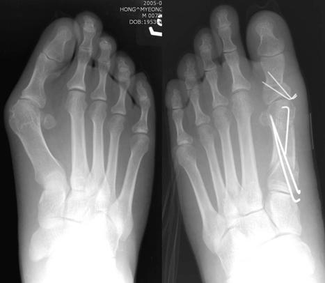 (B) This intraoperative AP finding shows tilting of the distal metatarsal articular angle of the 1st metatarsal bone after proximal chevron metatarsal osteotomy and Akin osteotomy.