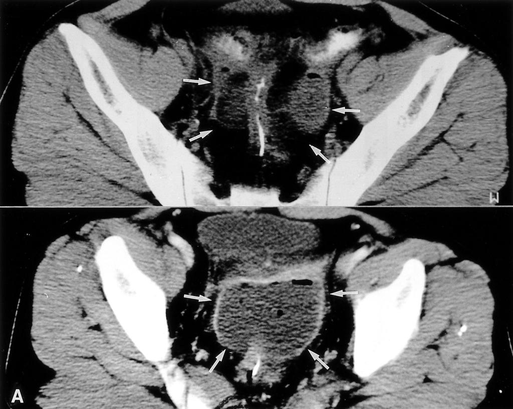 Young Mi Choi, et al : A case of intraabdominal abs ces s cured by transrectal catheter drainage Figure 2. B Figure 2. A Fig ure 2. CT s can of the pelvis.