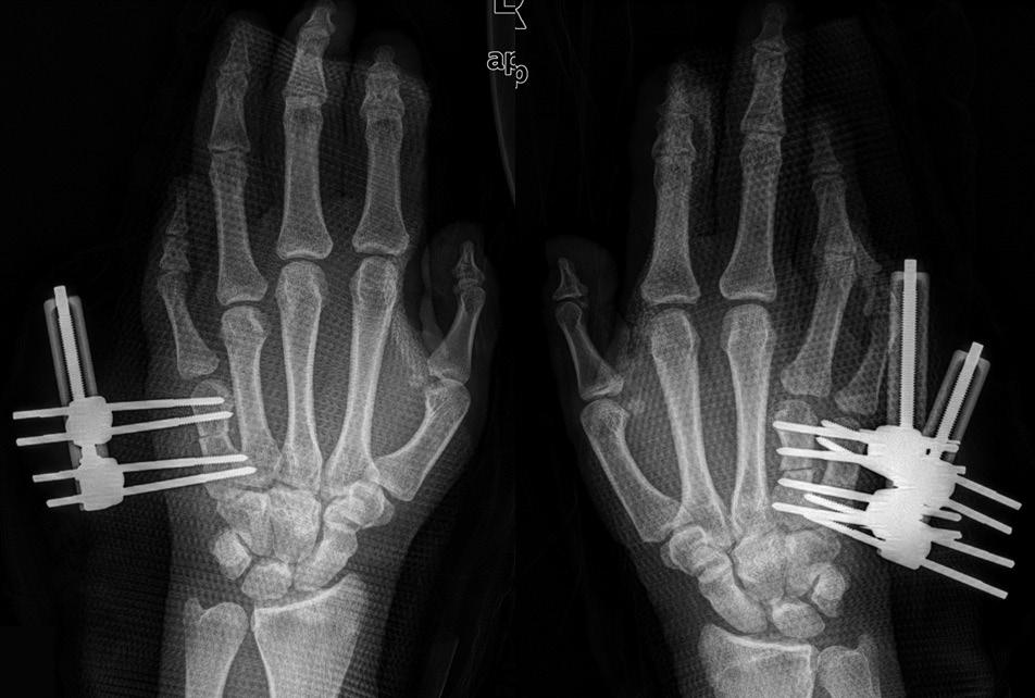 Radiographs show (A) osteotomy through the diaphysis using a unilateral