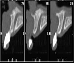 2) 비구개관비구개관은양측비강저에각각 1개씩 2개의구멍에서시작하여상악전치부설측에있는하나의 incisive foramen 으로연장되어있는 Y자형태의관이다 (Fig. 3). 그크기와모양은매우다양하다. 파노라마나구내방사선사진에서는협측에있는치조골로인하여비구개관이주행이정확히관찰되지않는경우가종종있다.