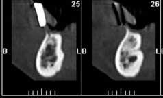 . Fig. 4. Cross-sectional image at the anterior maxilla. Fig. 5. Lingual vascular canal at the anterior mandible. 3) 하악관하악구치부에임플란트를할경우에치과의사가가장관심을가지는해부학적구조물은하악관이라고할수있겠다.