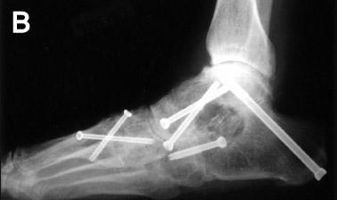 족근중족관절의특발성골관절염에대한수술적치료및임상적결과에대한분석 Figure 3. (A) This 66 year old male patient had a 10 year history of midfoot pain with long-term planovalgus deformity.