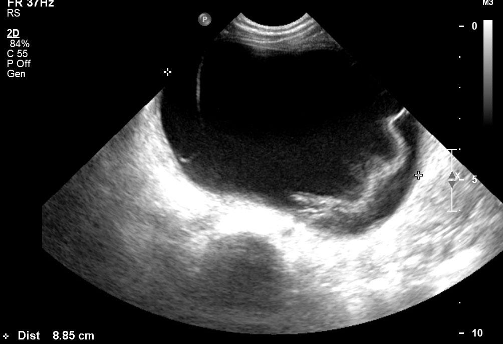부윤정 : 뇌실복강단락술후발생한복강내가성낭종 197 Fig. 1. Abdominal ultrasound howing huge cystic mass with internal septation on the right lower abdomen. Fig. 2.