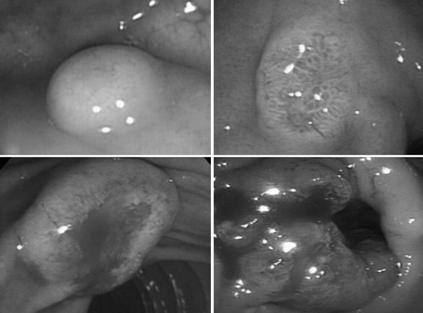 대한내과학회지 : 제 73 권제 3 호통권제 565 호 2007 A B C D Figure 2. Endoscopic features of the gastrointestinal carcinoid tumors. (A) A 5 mm sized rectal carcinoid tumor shows normal yellowcolored mucosa.