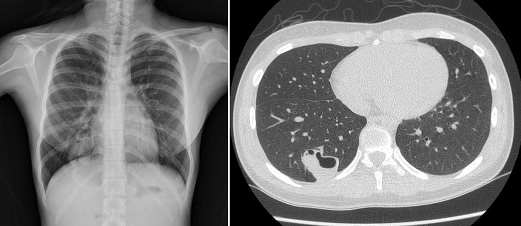 The Korean Journal of Medicine: Vol. 76, No. 2, 2009 A B Figure 1. (A) The chest radiograph shows cystic lung disease in the right lower lobe. (B) Computed tomography of the lung.