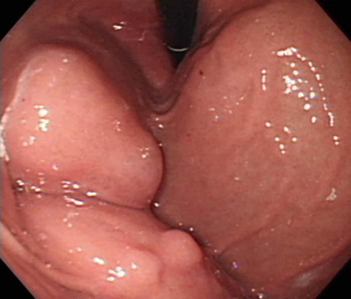 - Sung Min Lim, et al. Gastric duplication cyst with dorsal pancreatic agenesis and pulmonary cyst - Figure 3.