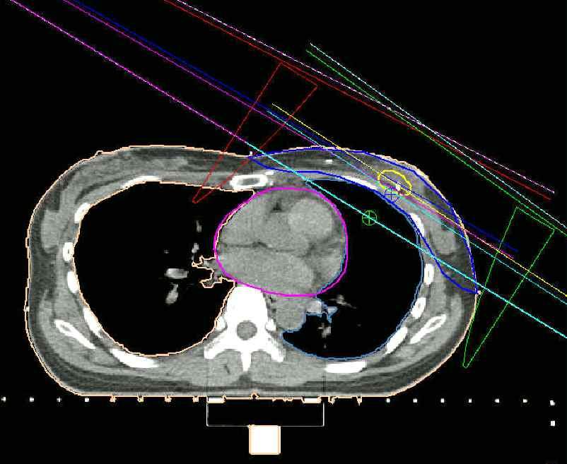 Dosimetric Characteristics of FIF Whole Breast Radiotherapy a) b1) b2) Fig. 1. Beam arrangement of 3DCRT and FIF.