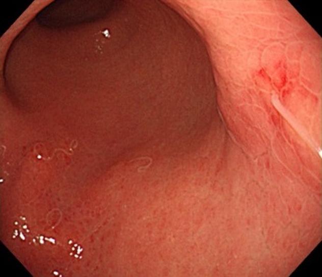 The most common infestation site is the greater curvature of the gastric