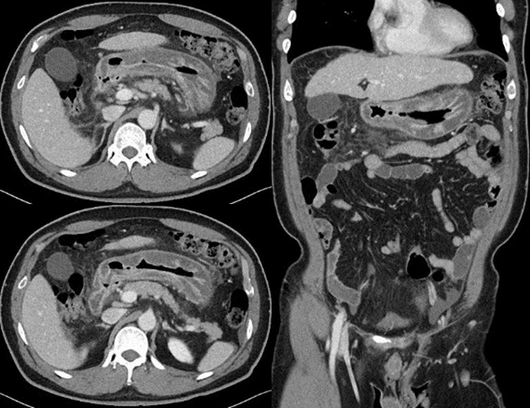 Heung Up Kim: Anisakidosis Fig. 2. Computed tomographic findings of anisakidosis. (A) Typical case of gastric anisakidosis.