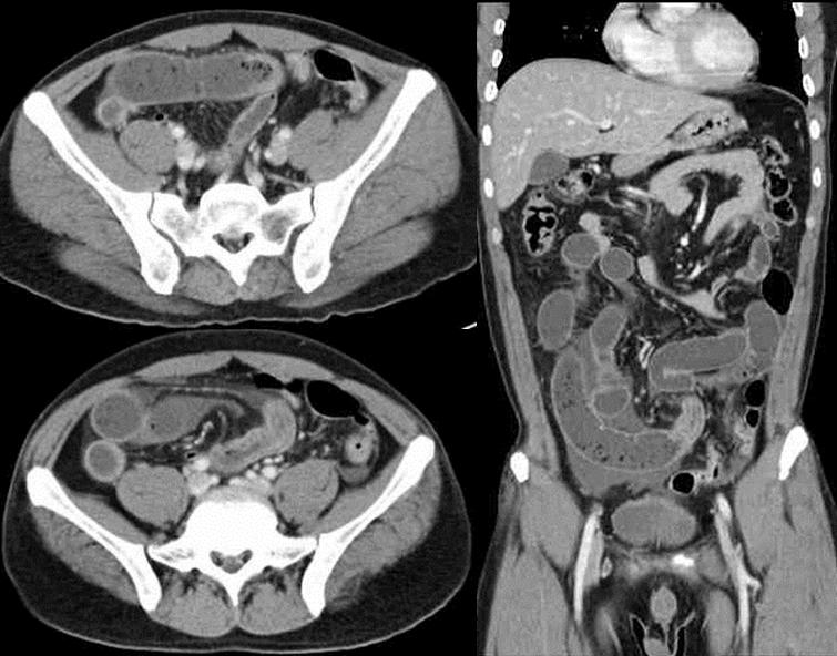 (B) Small bowel anisakidosis. Segmental small bowel edema with proximal dilatation of the bowel loops is seen. Mesenteric infiltration and ascites are also seen.