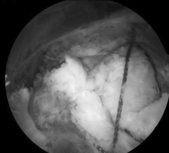 tears of the supraspinatus and infraspinatus tendons were repaired using a suture bridge tec hnique (B).